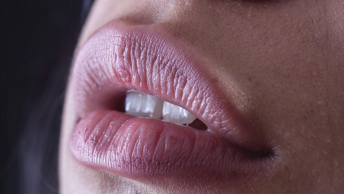 Зволожувати не можна: як швидко вилікувати потріскані кутики рота – кутовий хейліт - Краса