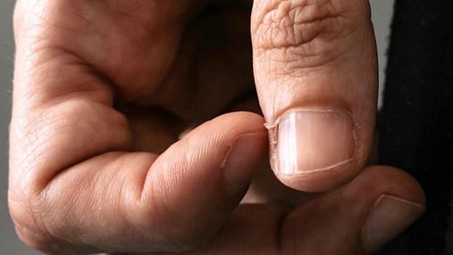 Заусенцы на пальцах: почему возникают и как избавиться